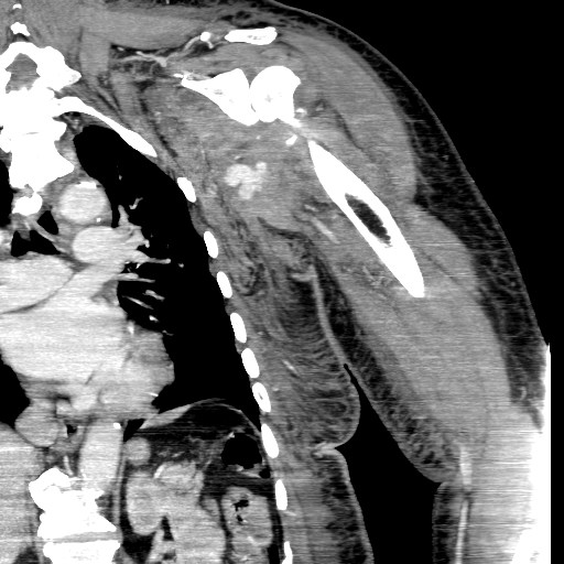 File:Axillary arterial pseudoaneurysm (Radiopaedia 24925-25195 B 9).jpg