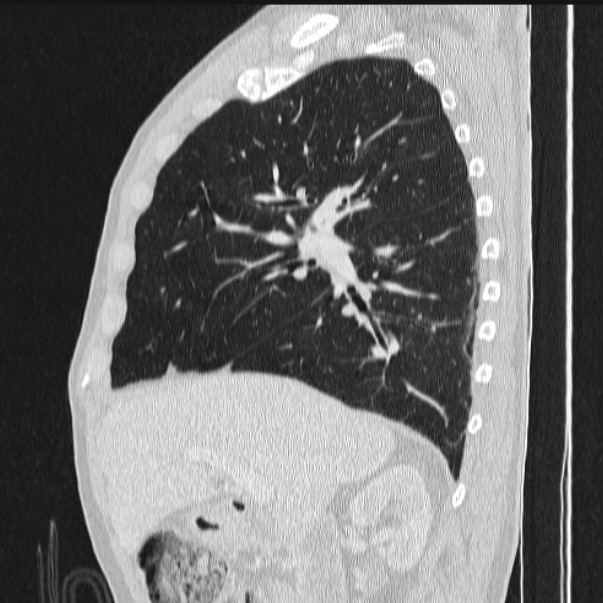 Azygos lobe (Radiopaedia 38259-40275 lung window 37).jpg