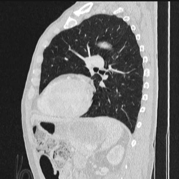 Azygos lobe (Radiopaedia 38259-40275 lung window 64).jpg