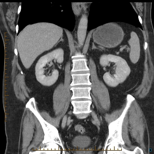 File:Bariatric balloon causing gastric outlet obstruction (Radiopaedia 54449-60672 B 38).jpg