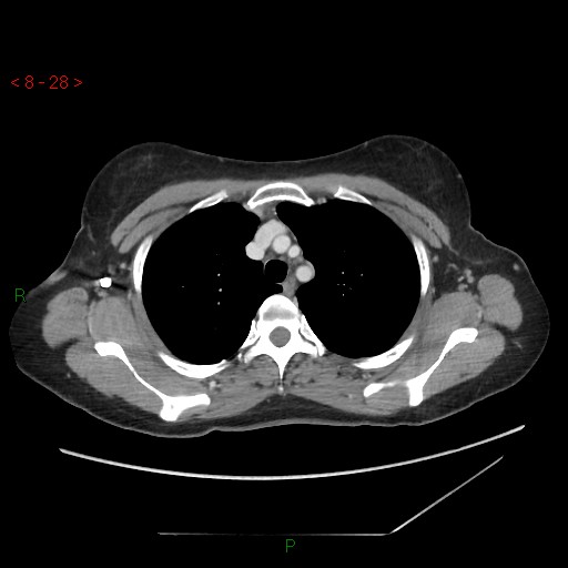 Bartholin gland cyst (Radiopaedia 54904-61181 A 7).jpg