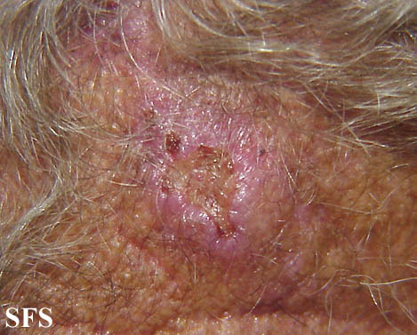 Basal Cell Carcinoma (Dermatology Atlas 71).jpg