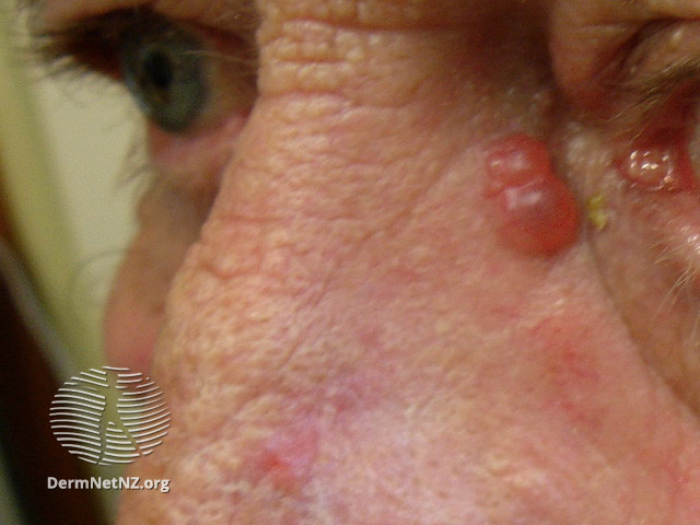 File:Basal cell carcinoma affecting the nose (DermNet NZ lesions-bcc-nose-1081).jpg