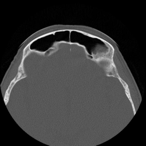 File:Base of skull chondrosarcoma (Radiopaedia 30410-31071 Axial bone window 36).jpg