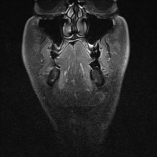 File:Base of tongue squamous cell carcinoma (Radiopaedia 31174-31884 E 18).jpg