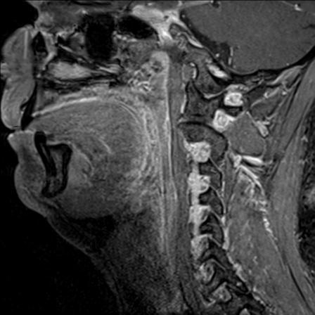 Base of tongue squamous cell carcinoma (Radiopaedia 31174-31884 F 107).jpg