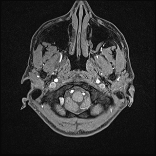 Basilar artery perforator aneurysm (Radiopaedia 82455-97733 Axial T1 fat sat 7).jpg