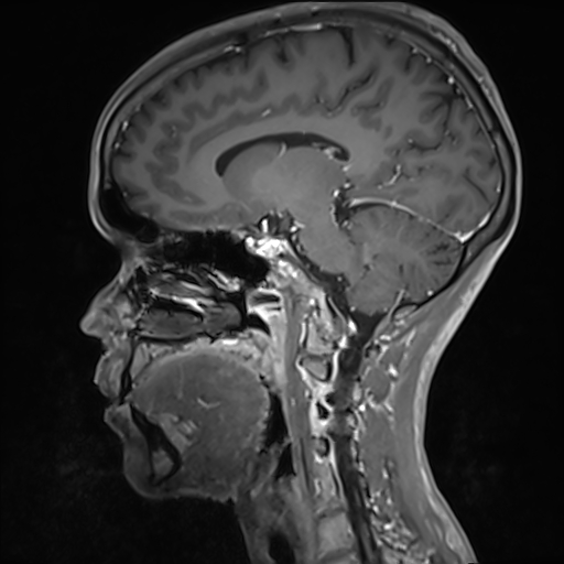 File:Basilar artery perforator aneurysm (Radiopaedia 82455-97733 G 86).jpg
