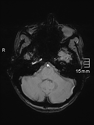 Basilar artery perforator aneurysm (Radiopaedia 82455-99523 Axial SWI 14).jpg