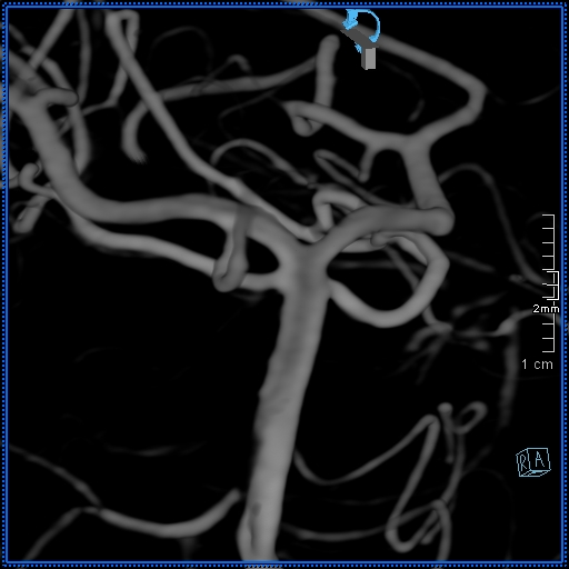 Basilar artery perforator aneurysm (Radiopaedia 82455-99524 3D Left VA 50).jpg