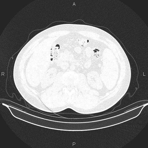 File:Beam hardening and ring artifacts (Radiopaedia 85323-100915 Axial lung window 86).jpg