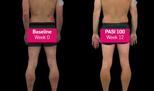 File:Before and after secukinumab (DermNet NZ before-and-after-secukinumab).png