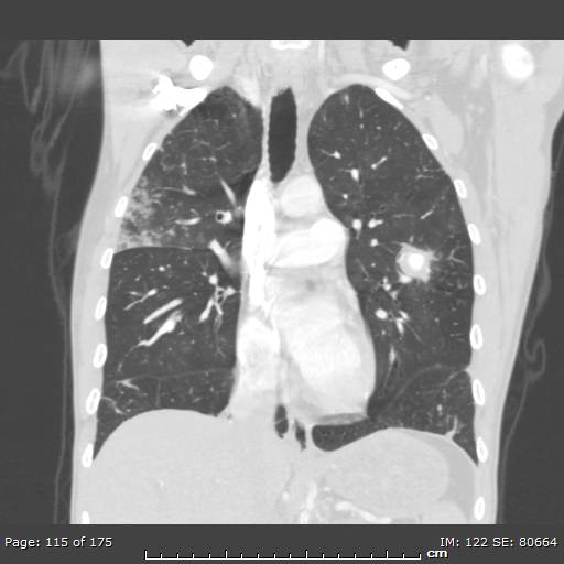 File:Behçet disease (Radiopaedia 44247-47889 Coronal lung window 35).jpg