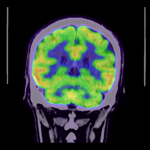 Behavioral variant frontotemporal dementia (Radiopaedia 62431-70673 B 37).png