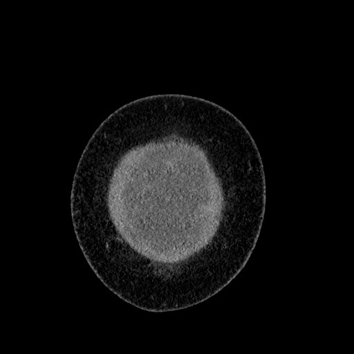 File:Benign leiomyoma with hydropic features (Radiopaedia 89250-106130 B 8).jpg