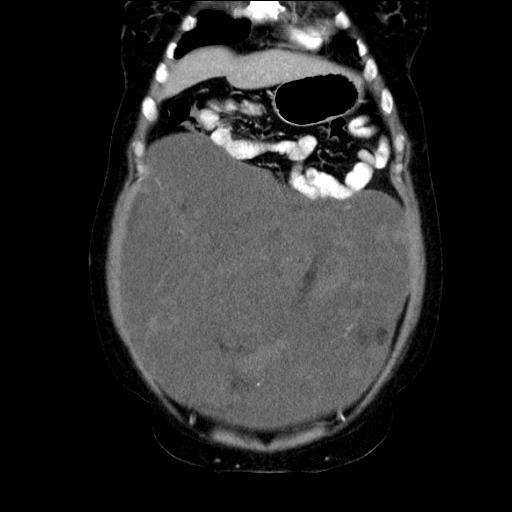 File:Benign spindle cell tumor - abdominopelvic (Radiopaedia 61300-69212 C 16).jpg