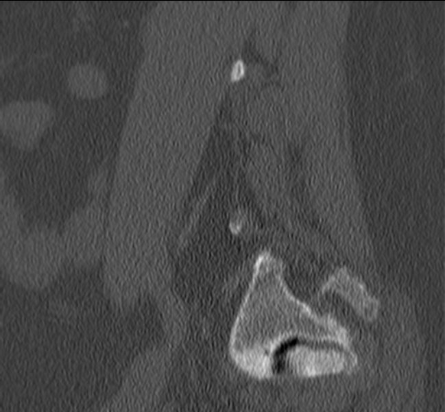Bertolotti syndrome (Radiopaedia 24864-25128 Sagittal bone window 10).jpg