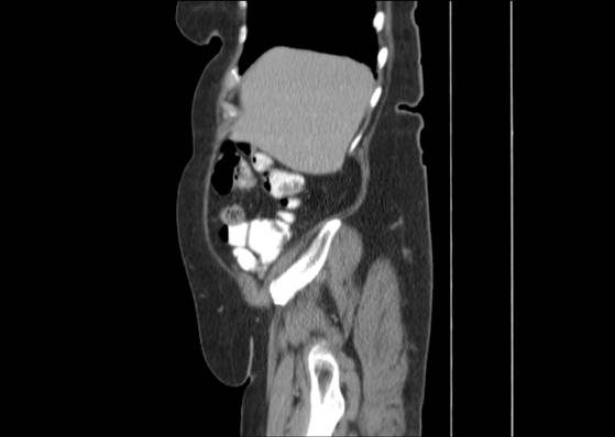 Bicameral celiacomesenteric aneurysm (Radiopaedia 55766-62327 B 12).jpg