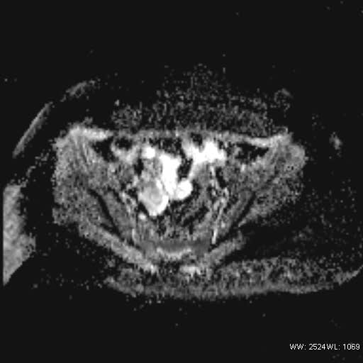 File:Bicornuate uterus- on MRI (Radiopaedia 49206-54297 Axial ADC 10).jpg