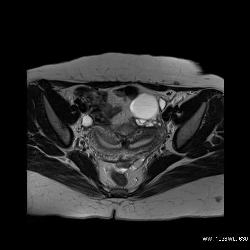 File:Bicornuate uterus- on MRI (Radiopaedia 49206-54297 Axial T2 7).jpg
