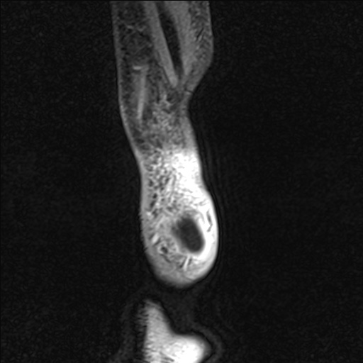 Bilateral Achilles tendon complete tear (Radiopaedia 81344-95051 Sagittal WE - Left 104).jpg