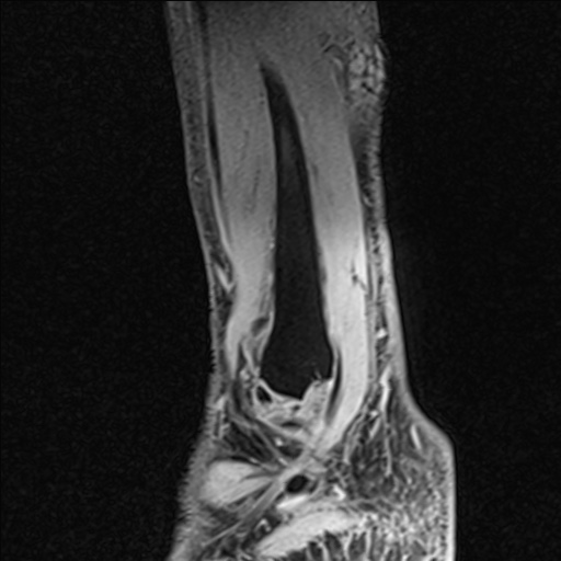 Bilateral Achilles tendon complete tear (Radiopaedia 81344-95051 Sagittal WE - Right 25).jpg