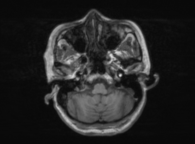 Bilateral PCA territory infarction - different ages (Radiopaedia 46200-51784 Axial T1 321).jpg