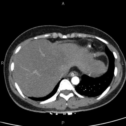 Bilateral adrenal gland hyperenhancement in pancreatitis (Radiopaedia 86642-102753 B 13).jpg