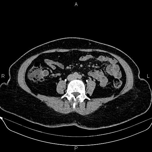 Bilateral benign adrenal adenomas (Radiopaedia 86912-103124 Axial C+ delayed 93).jpg