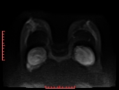 File:Bilateral breast implant rupture (Radiopaedia 24761-25027 DWI 20).jpg