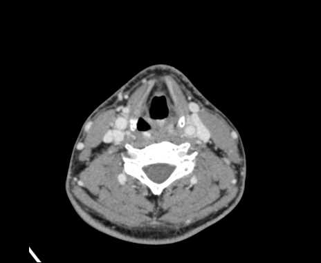 Bilateral carotid body tumors (Radiopaedia 61841-69870 Axial Post contrast 67).jpg