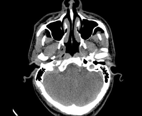 Bilateral carotid body tumors (Radiopaedia 61841-69870 Axial non-contrast 5).jpg