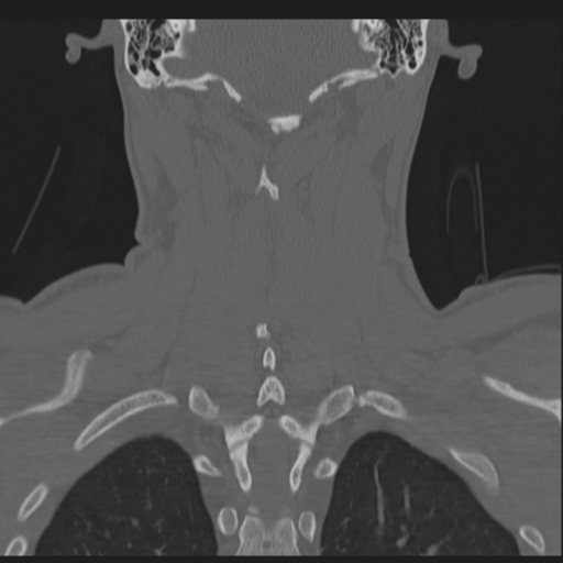 Bilateral locked facets (Radiopaedia 33850-35016 Coronal bone window 65).png