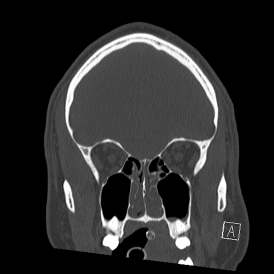 Bilateral occipital condyle fracture (type 2) (Radiopaedia 87675-104089 Coronal bone window 22).jpg