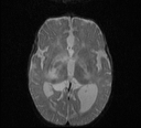 File:Bilateral optic pathway gliomas (Radiopaedia 40013-42514 Axial DWI 9).jpg