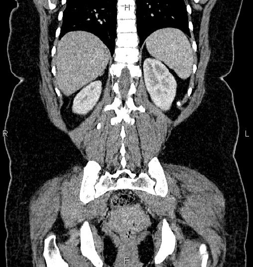 File:Bilateral ovarian dermoid cysts (Radiopaedia 85785-101603 C 46).jpg