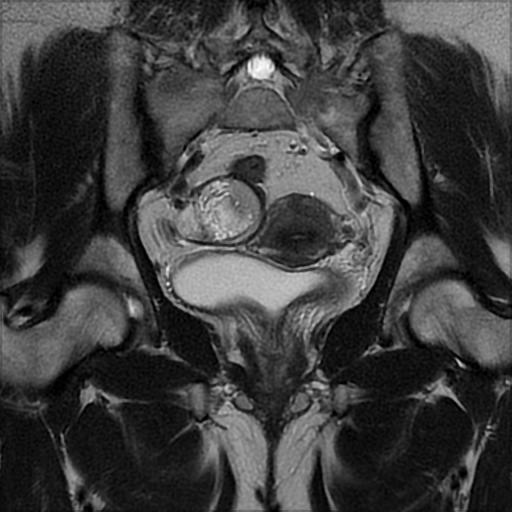 File:Bilateral ovarian dermoid cysts (Radiopaedia 90152-107338 Coronal T2 17).jpg