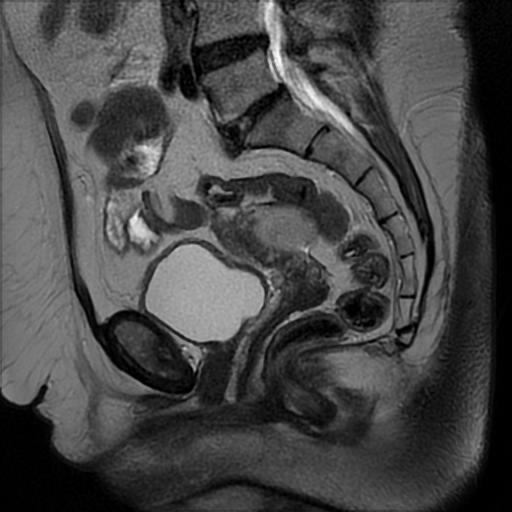 File:Bilateral ovarian dermoid cysts (Radiopaedia 90152-107338 Sagittal T2 12).jpg