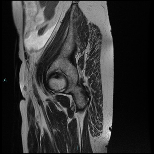 File:Bilateral ovarian fibroma (Radiopaedia 44568-48293 Sagittal T2 1).jpg