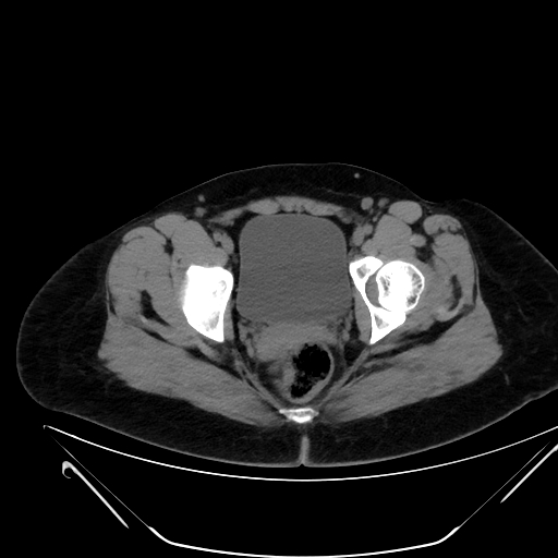 Bilateral ovarian mature cystic teratomas (Radiopaedia 79373-92457 Axial non-contrast 80).jpg