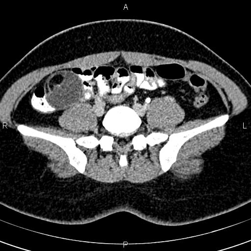 Bilateral ovarian teratoma (Radiopaedia 83131-97503 B 12).jpg