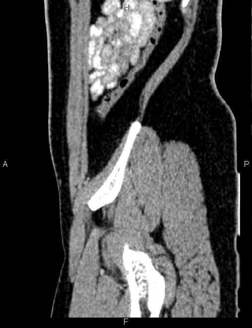 Bilateral ovarian teratoma (Radiopaedia 83131-97503 D 96).jpg