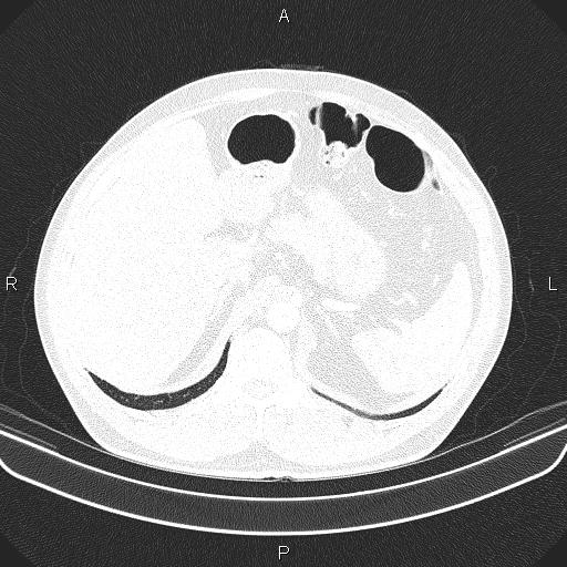 File:Bilateral pulmonary AVM (Radiopaedia 83134-97505 Axial lung window 74).jpg