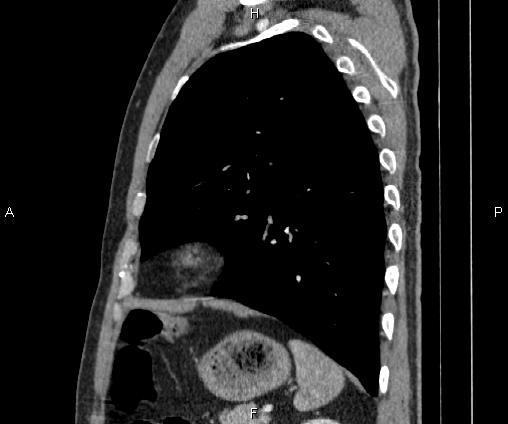Bilateral pulmonary AVM (Radiopaedia 83134-97505 D 84).jpg