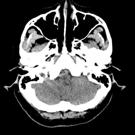 Bilateral subacute subdural hematoma (Radiopaedia 69240-79018 Axial non-contrast 8).jpg