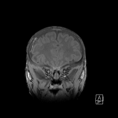 Bilateral subdural hemorrhage and parietal skull fracture (Radiopaedia 26058-26190 Coronal T1 13).png