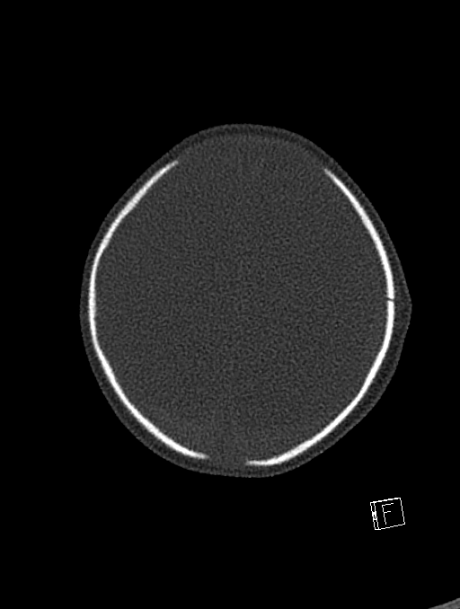 Bilateral subdural hemorrhage and parietal skull fracture (Radiopaedia 26058-26192 Axial bone window 22).png