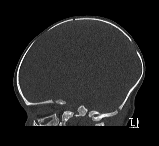 Bilateral subdural hemorrhage and parietal skull fracture (Radiopaedia 26058-26192 Sagittal bone window 59).png