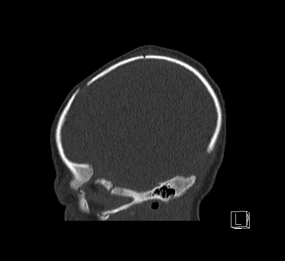 Bilateral subdural hemorrhage and parietal skull fracture (Radiopaedia 26058-26192 Sagittal bone window 82).png