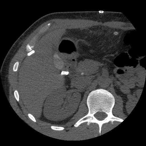 Bile leak from liver traumatic laceration (Radiopaedia 63463-72077 Axial Biliscopin 51).jpg